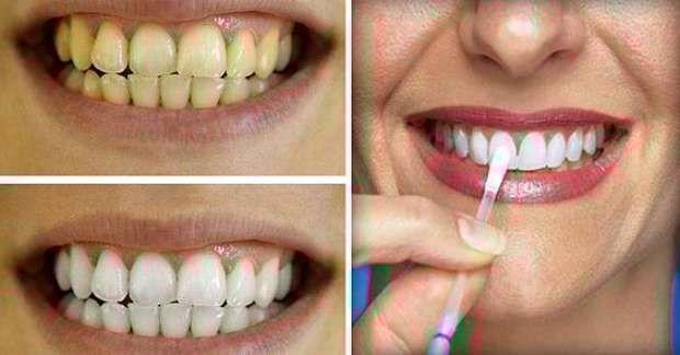 How to bleach the teeth with apple cider vinegar