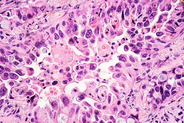 Étudier l'effet du vaccin ARNm Covid-19 sur les cellules épithéliales du carcinome pulmonaire humain en utilisant la spectroscopie Raman et l'imagerie