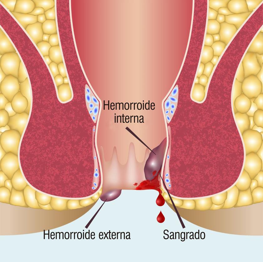 Hemorroides: qué son, causas, síntomas y tratamiento