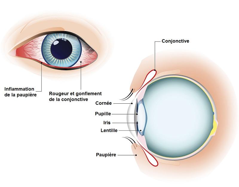 Conjonctivite et inflammation de l'oeil 