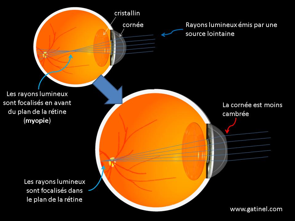 Chirurgie réfractive (laser, implant) : tout savoir sur les opérations des yeux 