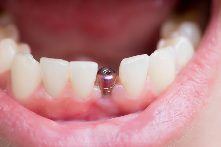 Implant dentaire : tout ce qu'il faut savoir avant l'opération 