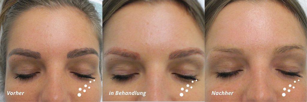 Removing to get znovu of Microblading and Co. 