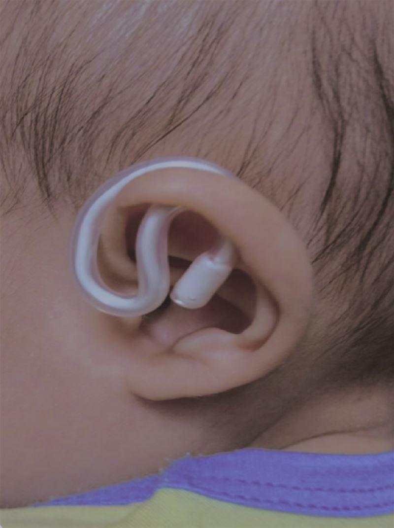 ＪＤＦの埋没耳矯正器具、肌の負担を減らすカギは？｜ニュースイッチ by 日刊工業新聞社 