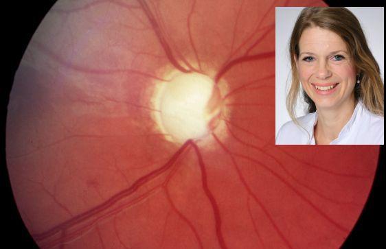 Glaucoma más allá de la impresión de ojos
