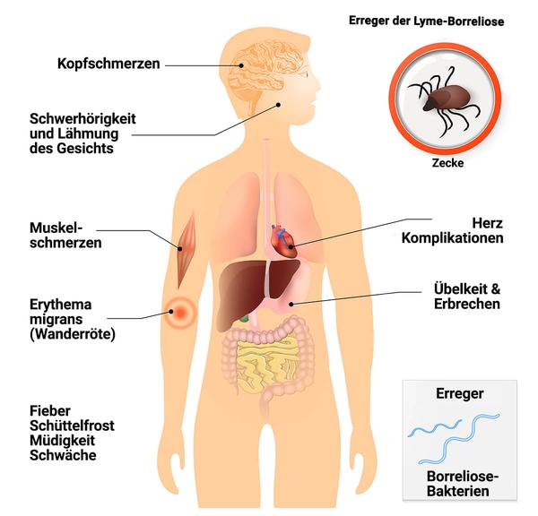 Infektion nach Zeckenstich: Was tun bei Borreliose-Anzeichen?