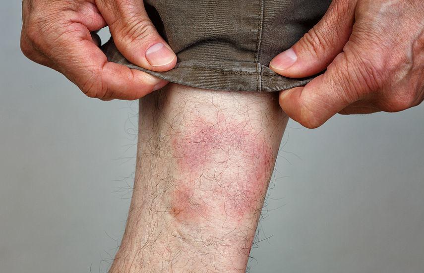 Infección después de una picadura de garrapata: qué hacer ¿Qué hacer con la enfermedad de Lyme -Signos? 
