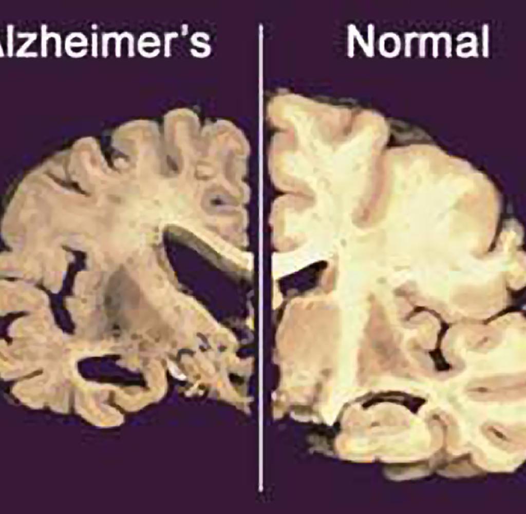 ¿Es el aluminio la causa del Alzheimer?