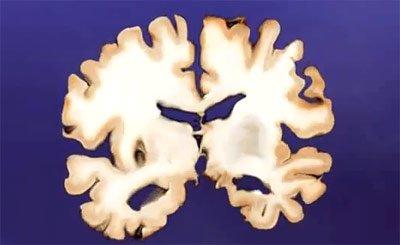 Ist Aluminium die Ursache von Alzheimer? 