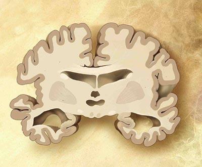 Neuer Wirkstoff gegen Alzheimer und Parkinson auf dem Weg zum Medikament 