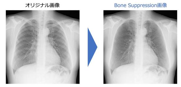 「こんなの使えない」と文句を言った医師がファンに　ボーンサプレッション開発秘話 連載：イノベーションの「リアル」｜ビジネス+IT 