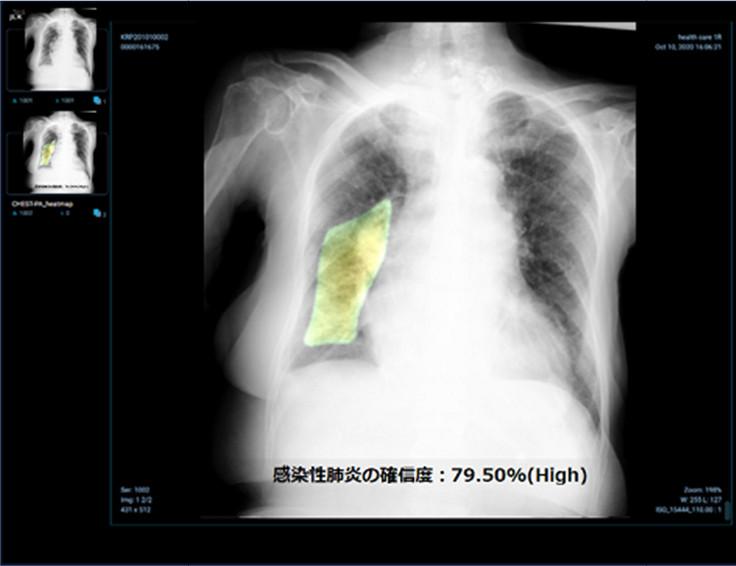 新型コロナウイルス肺炎を含む感染性肺炎の画像診断を支援する胸部X線AIエンジンの薬事承認を日本で初めて取得