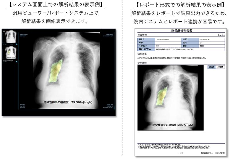 新型コロナウイルス肺炎を含む感染性肺炎の画像診断を支援する胸部X線AIエンジンの薬事承認を日本で初めて取得 