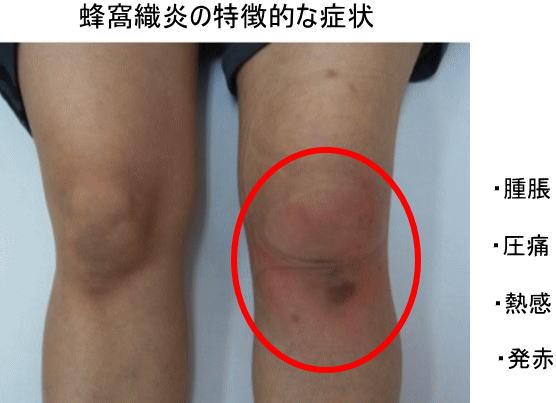 News The bacteria invade from the wounds that swollen their feet and hands swollen and scratched.