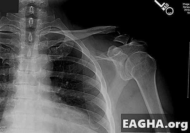 Clavicle fracture.. Impact sports disease