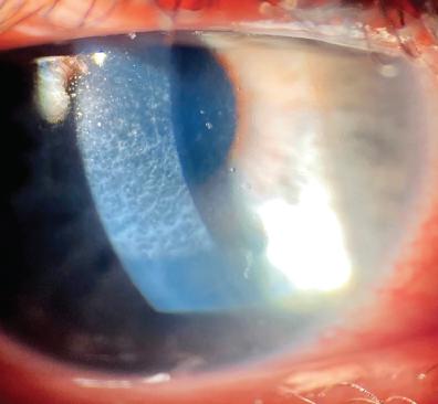How Corneal Haze Can Cause Changes in Your Vision 