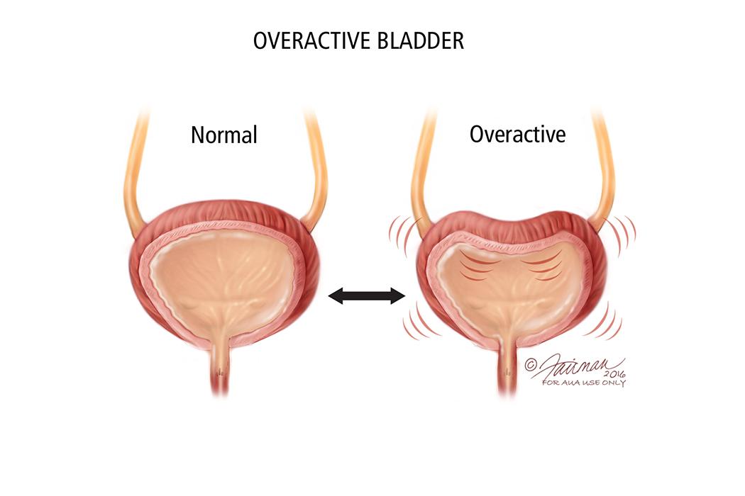 Overactive Bladder