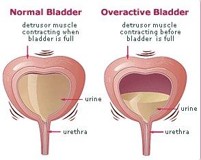 Overactive Bladder 