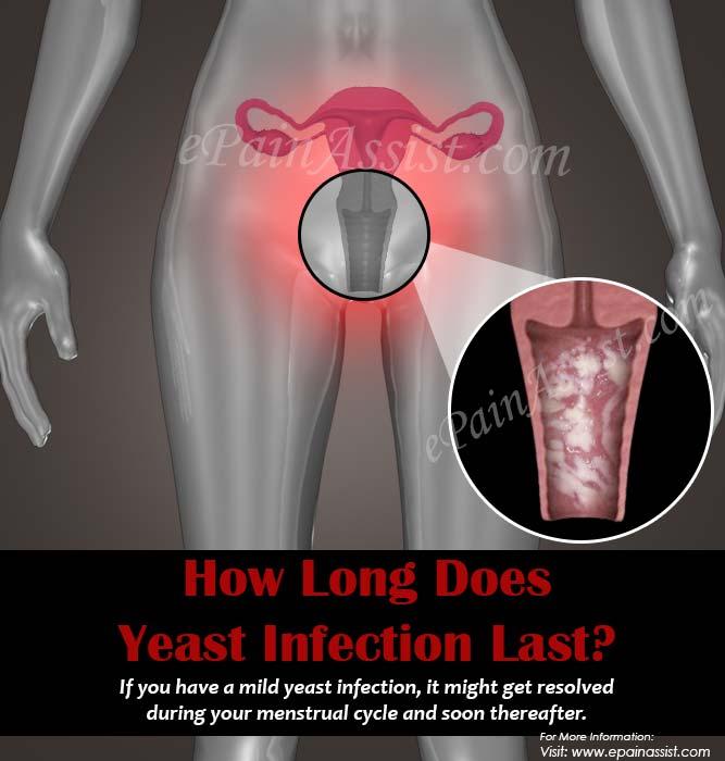 How Long Does a Yeast Infection Last?