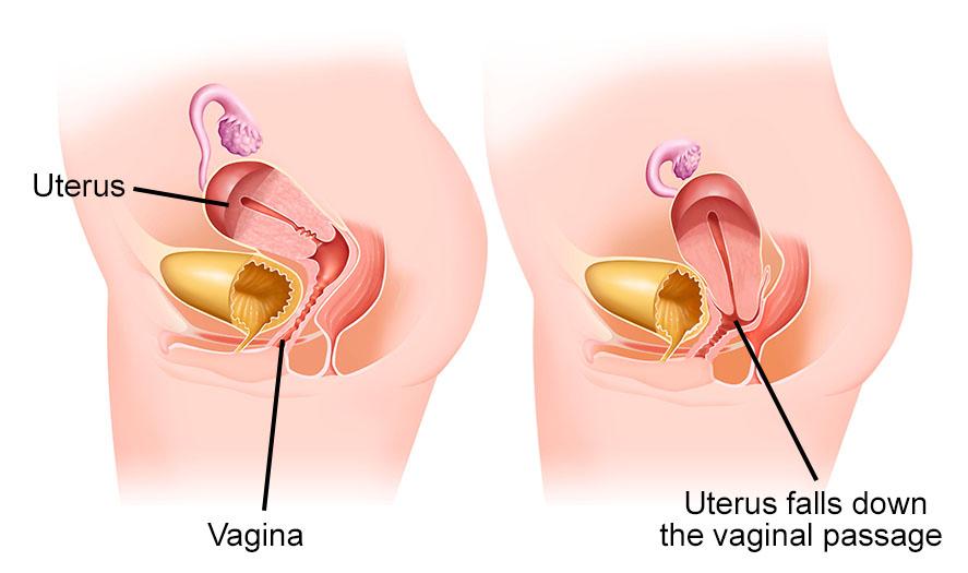What Is Vaginal Prolapse?