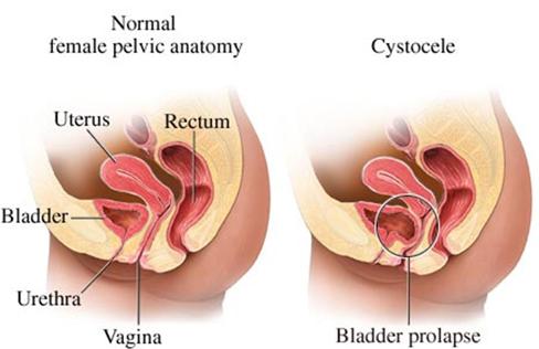 What Is Vaginal Prolapse? 