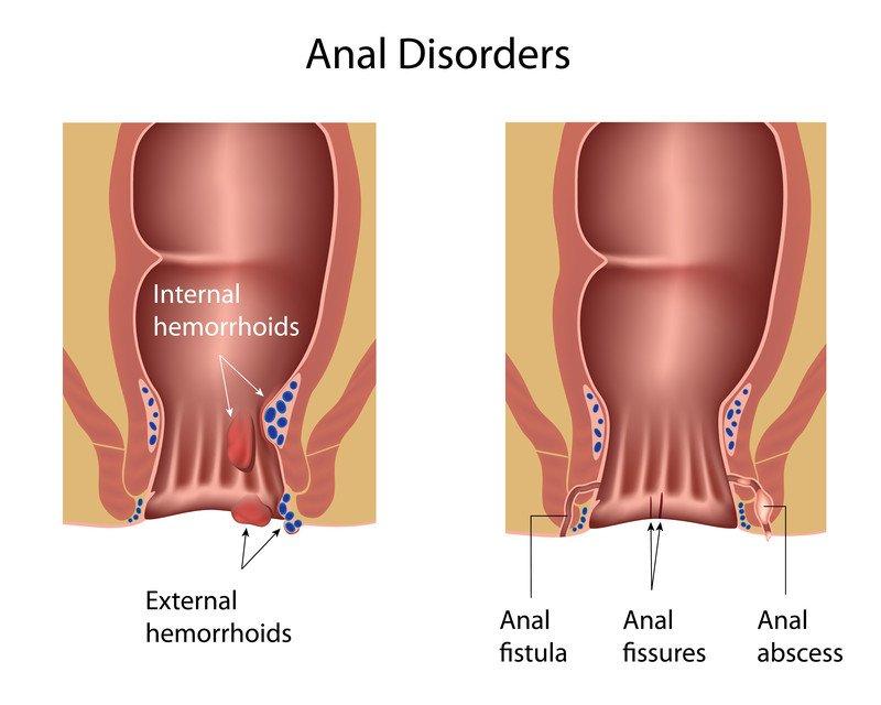 What Can Cause Hemorrhoids to Have an Odor?