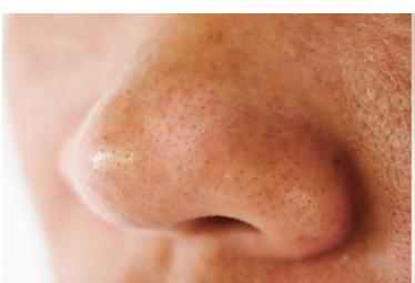 How to cure "strawberry nose"? A US dermatologist explains the causes of blackheads in pores and how to remove them