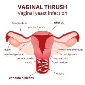 What to know about vaginal infections