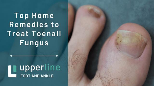 Can home remedies help get rid of toenail fungus?