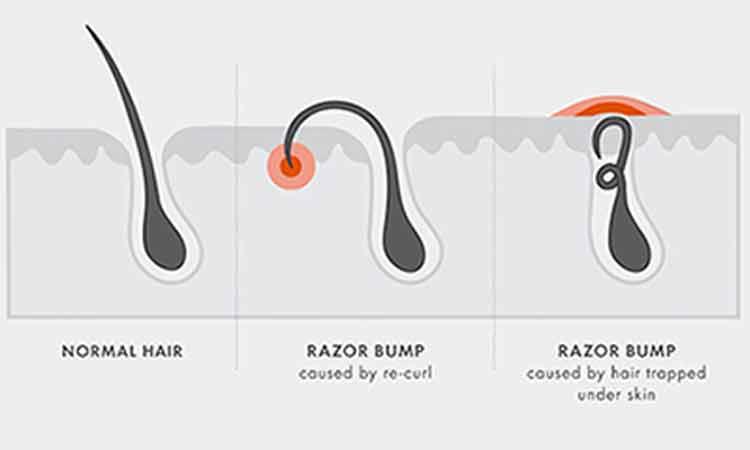 How to Treat a Razor Burn in the Pubic Area 