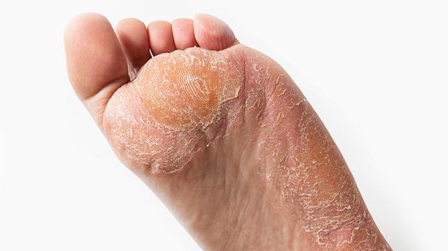 Can You Get Ringworm on Your Feet?