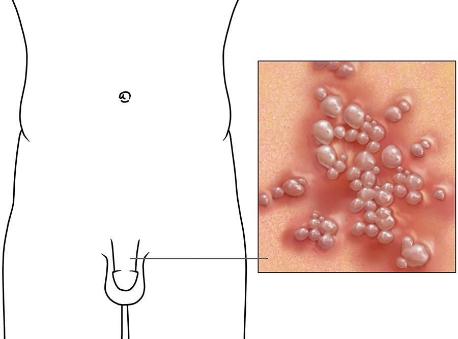 Genital Herpes: Everything You Need to Know