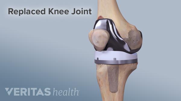 When Is It Time for a Knee Replacement? 