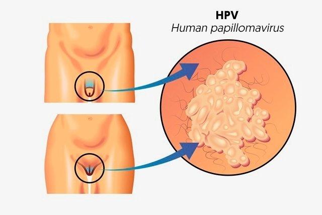 HPV Infection in Men 