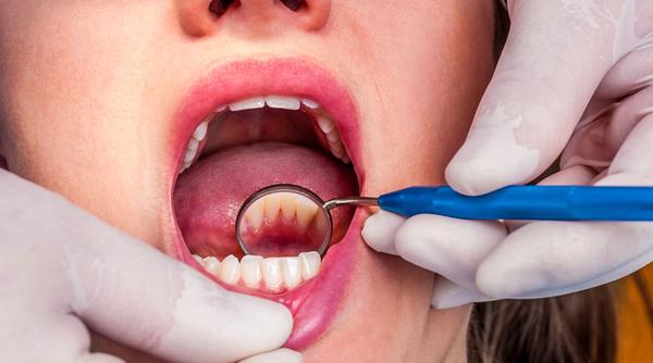 Teeth Cleaning: What to Expect 