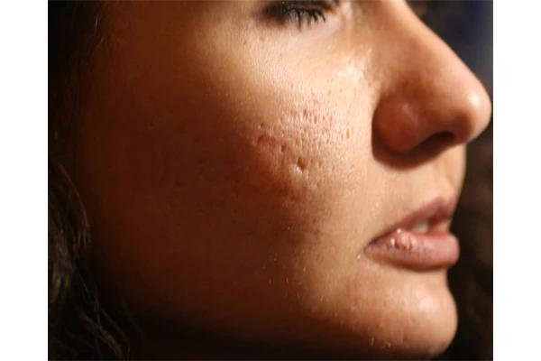 How to get rid of acne scars, according to experts