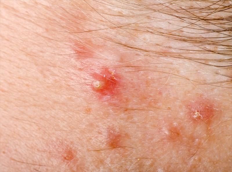 Folliculitis: What It Is and What You Can Do About It