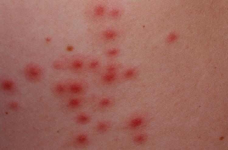 Folliculitis: What It Is and What You Can Do About It 