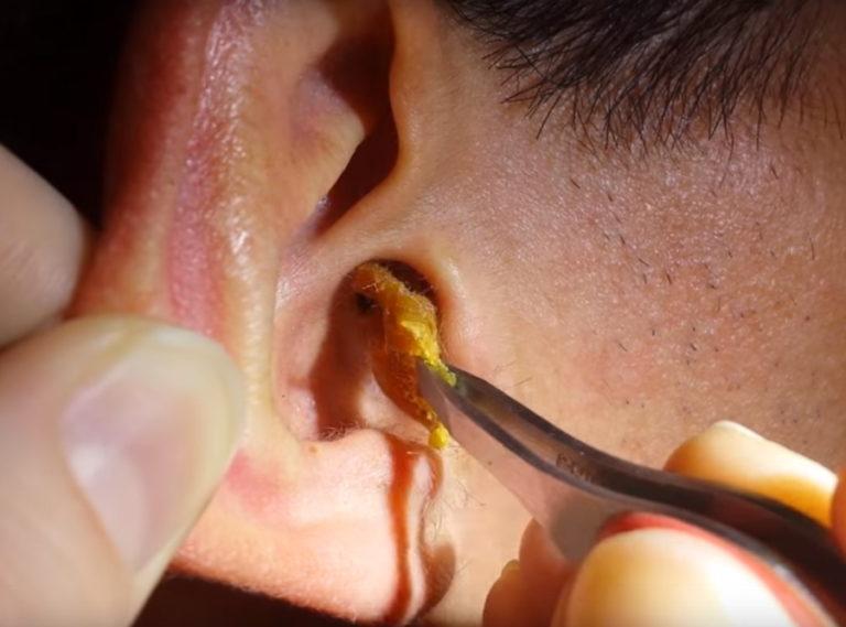 What to Do if You Have an Earwax Blockage
