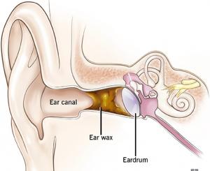 What to Do if You Have an Earwax Blockage 