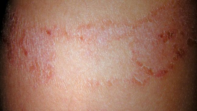 Skin Allergy Types and Triggers 