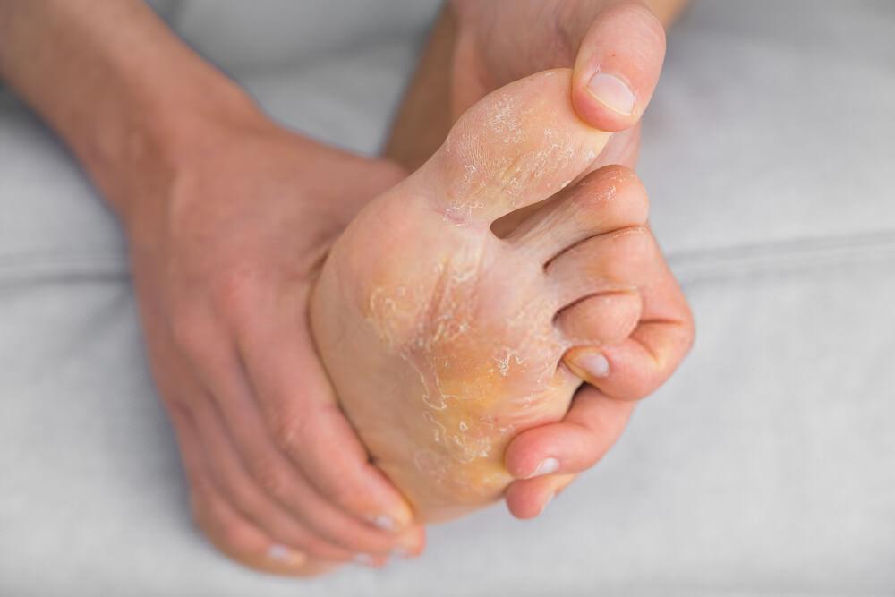 Clean shoes: the key to curing athlete's foot