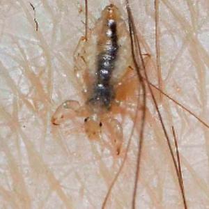 What You Should Know About Pubic Lice