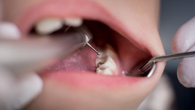 "There is no merit for 40 % of failure" A "certain treatment" that should never be received by a dentist [2021 second half BEST5] "Nerve of teeth" should be left as much as possible