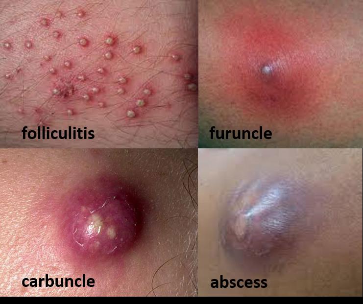 Folliculitis, Furuncles, and Carbuncles Skin Infections