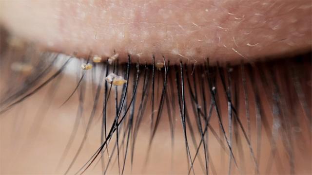 How Pubic Lice Can Spread to Your Eyelashes, According to Doctors