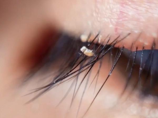 How Pubic Lice Can Spread to Your Eyelashes, According to Doctors 