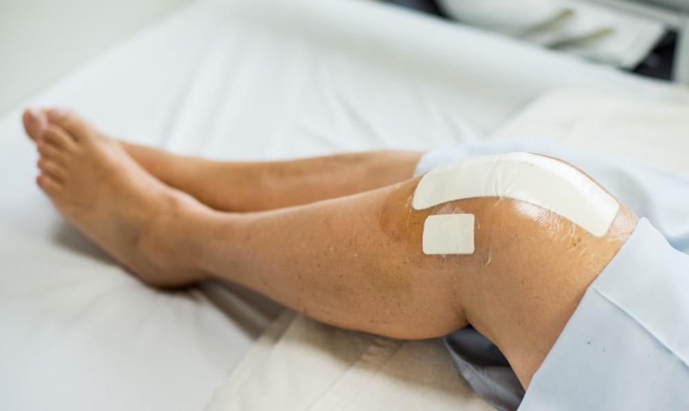 How to Prepare for Recovery After Knee Replacement Surgery 