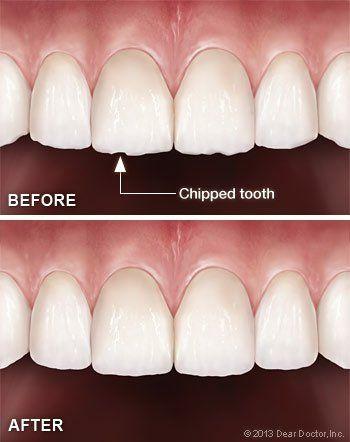 Tooth Contouring and Reshaping Tips 
