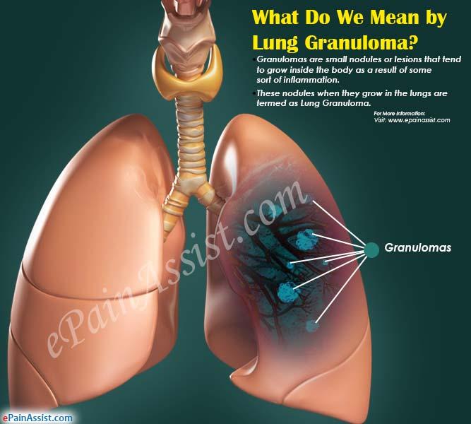 What Is a Lung Granuloma? 